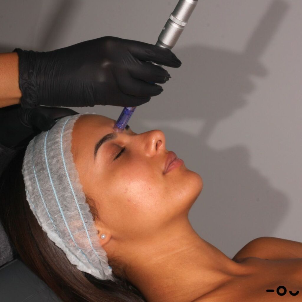 Microneedling en Vela Segalà Barcelona