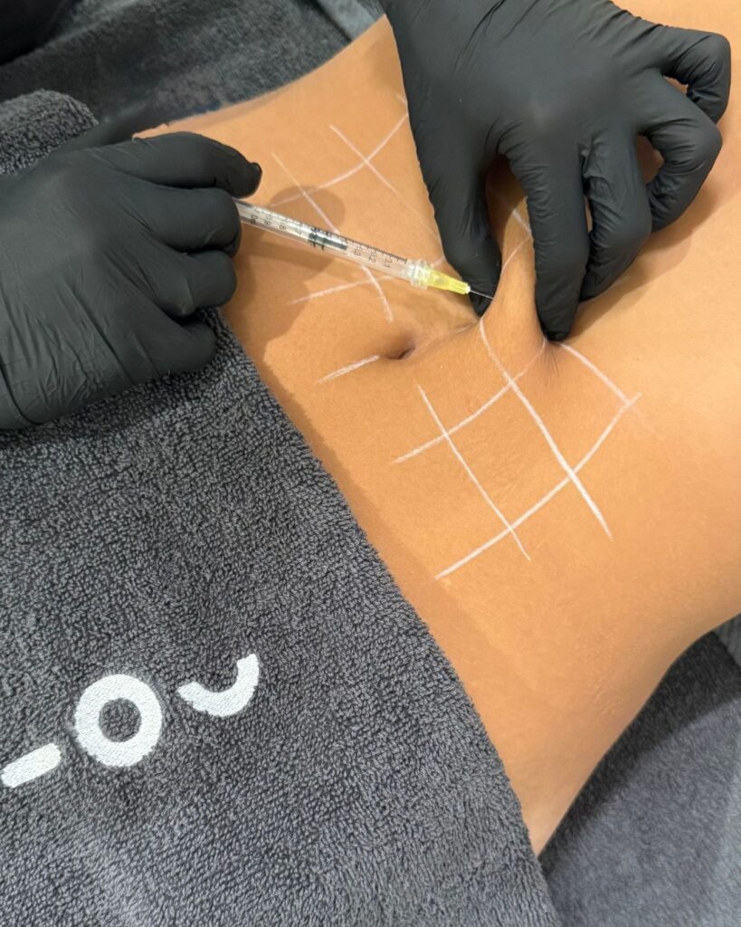 mesoterapia corporal vela segalà
